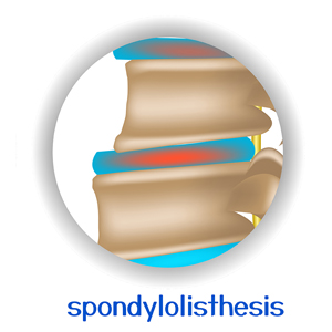 image of Augusta chiropractic spondylolisthesis